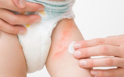 Ömeryem - Kantoron Etkili Pişik Kremi (2)